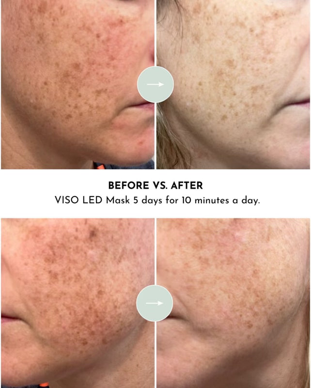 VISO Red Light Therapy Mask — FDA Certified